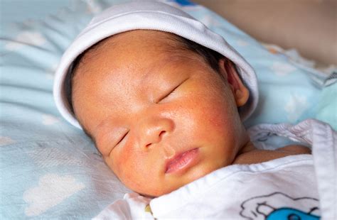 Brightening Little Smiles: 5 Natural Ways To Treat Infant Jaundice At Home