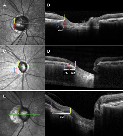 Microstructure of Peripapillary Atrophy and Subsequent Visual Field ...