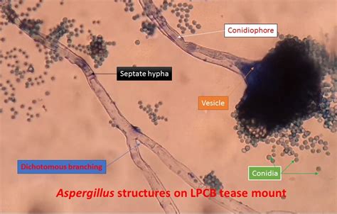 Aspergillus structures on LPCB tease mount and its LPCB Preparation