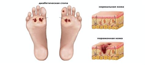 Макроангиопатия при сахарном диабете - причины и методы лечения