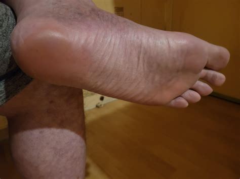 Soles of my bare feet exposing hard skin, corns.. : r/Roughmalefeet