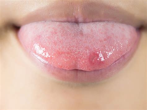 Oral Lesions Under Tongue