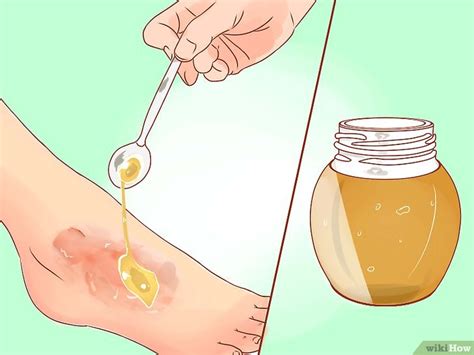 O Que Fazer Com Bolha De Queimadura