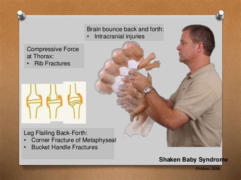 Bucket Handle Fracture Bucket Handle Meniscal Tear And The “double