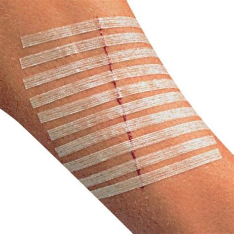 Sterile Wound Closure Strips (Butterfly Stitches) - MedicalDressings