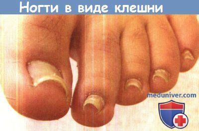 Травматическое повреждение ногтя - признаки, лечение