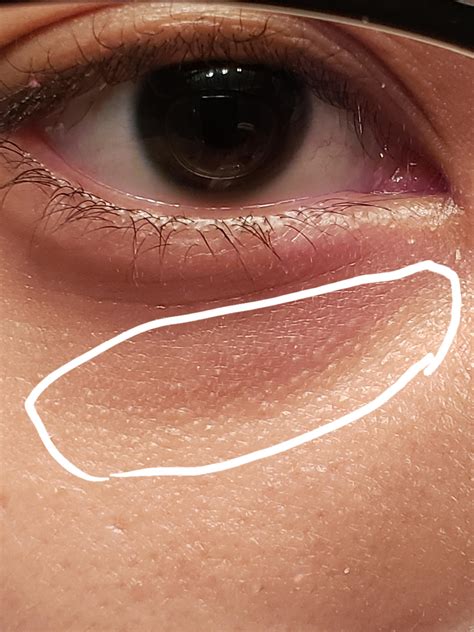 What Does The Black Line Under Your Eyes Mean at Nathaniel Ackerman blog