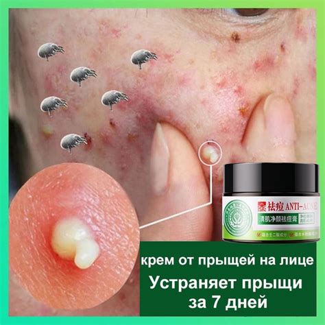Крем для лица от акне прыщей воспалений, постакне быстрое заживление ...