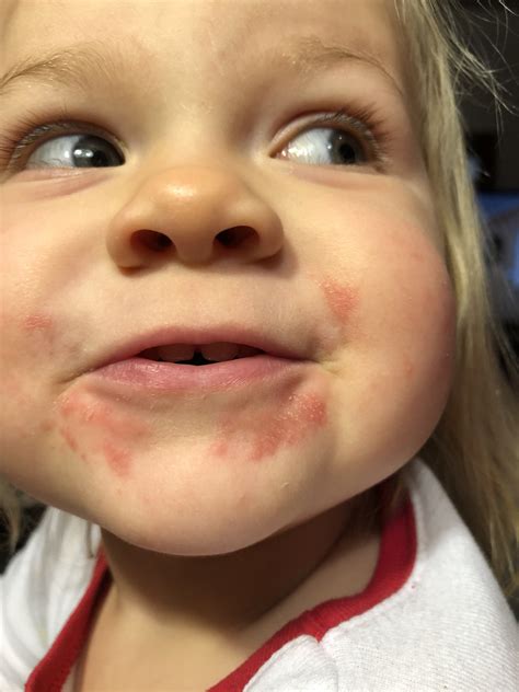 rash around her mouth- what to do? - February 2017 Babies | Forums ...