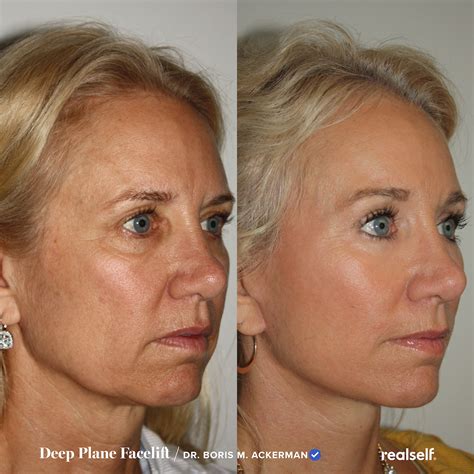 Deep plane facelift procedure cost recovery – Artofit