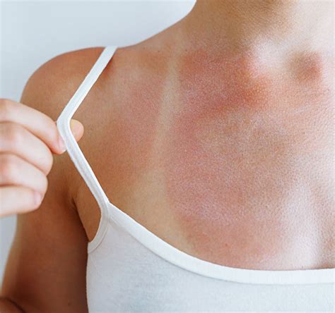 sun sensitivity avoid   products   sun