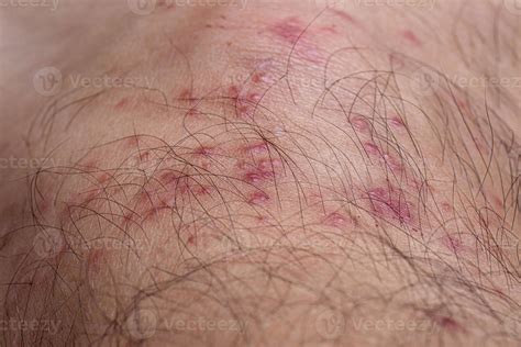 allergic reactions to tick bites 9230607 Stock Photo at Vecteezy