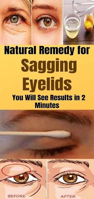 Natural Remedy For Sagging Eyelids You Will See Results In 2 Minutes ...