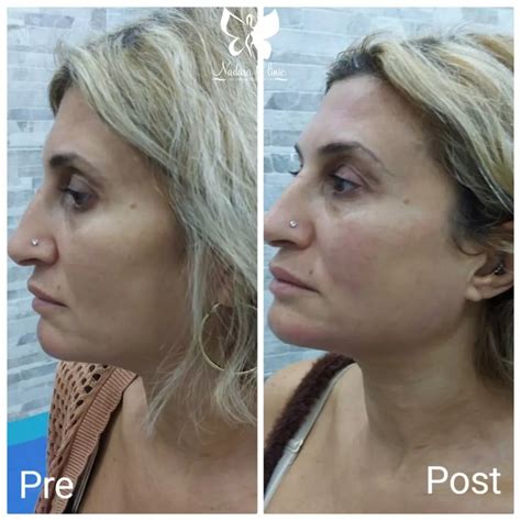 Hifu face lift | hifu face lift | Freshness Center for Dermatology and ...
