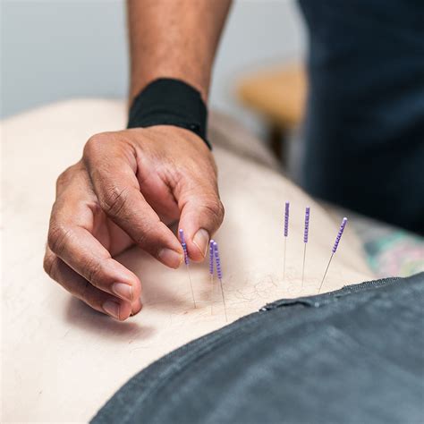 Can Dry Needling Cause Muscle Pain at Betty Coleman blog