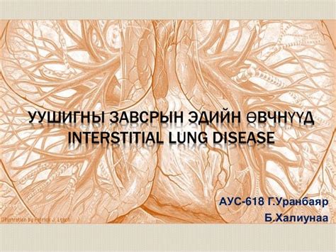 уушигны завсрын эдийн өвчнүүд