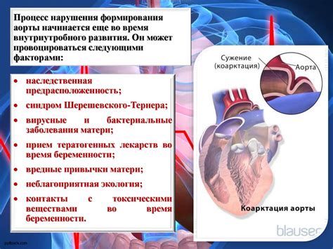 Коарктация аорты - презентация онлайн