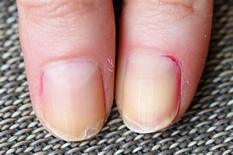 What Causes White Spots On Your Fingernails - Design Talk
