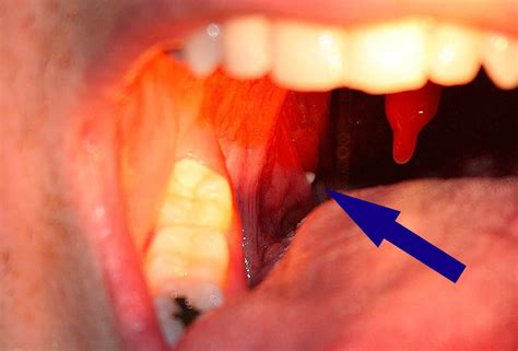 Tonsilloliter: Behandling, symptom, förebyggande åtgärder