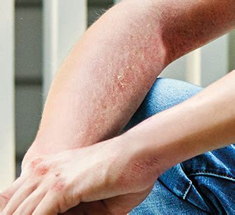 understanding eczema symptoms  eczema exposed