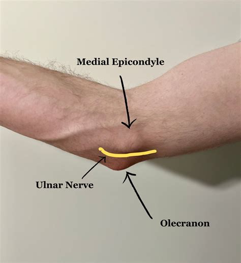 What Is Cubital Tunnel Syndrome? The Ultimate Patient Guide — Dr. Nick