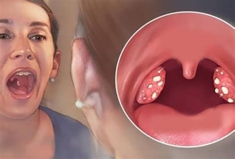 O Que Sao Bolinhas Brancas Na Garganta - Cáseos Amigdalianos: O que são essas bolinhas mal cheirosas que se ...