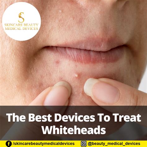 The Best Devices To Treat Whiteheads
