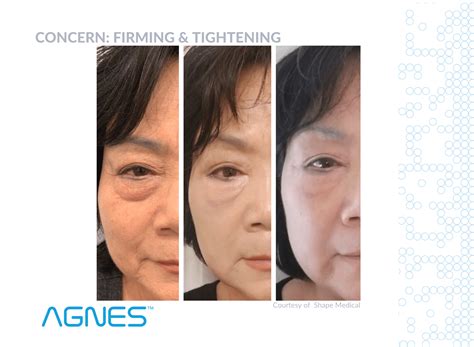 AGNES RF – Fat Removal that tightens smooths and sculpts – Well Medical
