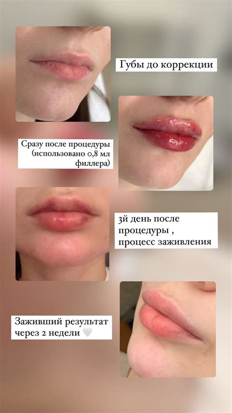 Процесс заживление | Lips inspiration, Face plastic surgery, Lip fillers