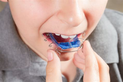 Removable braces - Kieferorthopädie Lyssbachpark
