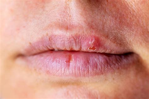 Labbra secche e screpolate: cause e rimedi
