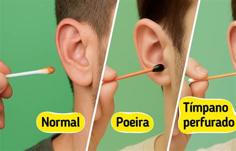 Tipos De Cera De Ouvido
