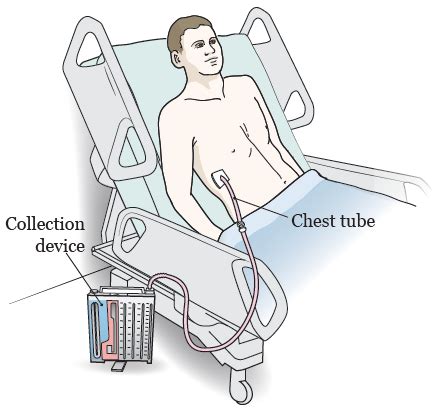 chest tube placement procedure memorial sloan kettering