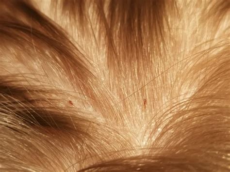 What Do Head Lice Eat? | LiceDoctors