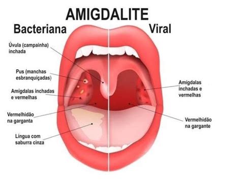 Lingua Inflamada Perto Da Garganta - Como Tratar a Garganta Inflamada - Perder Peso Aqui
