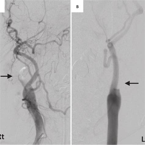 case  acute simultaneous bilateral internal carotid artery