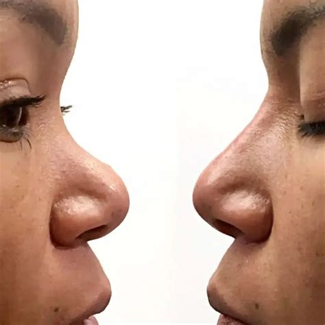 NoseFix: Filler | BeautyFix MedSpa - (212) 366-4787