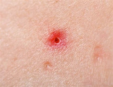 Understanding the Causes of Red Spots on the Skin — JIET Hospital