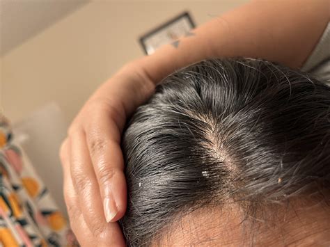 Is this seborrheic dermatitis ? Please help! It flames up the most