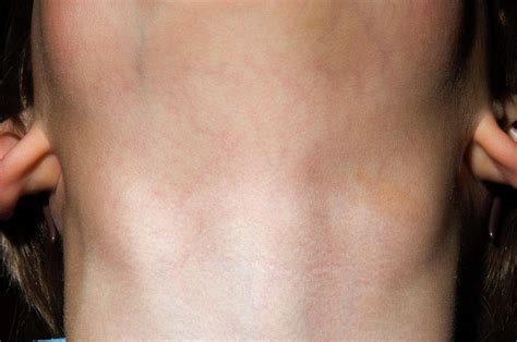 Swollen Lymph Nodes In Neck | Images and Photos finder