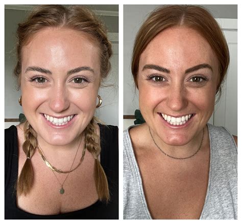 Unbelievable Blackhead Removal 2024: My Honest Review & Before/After Pics. Image 8