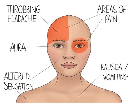 Migraine Prevention