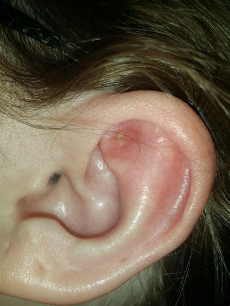 Best zit videos that are grossing out the entire internet now 34