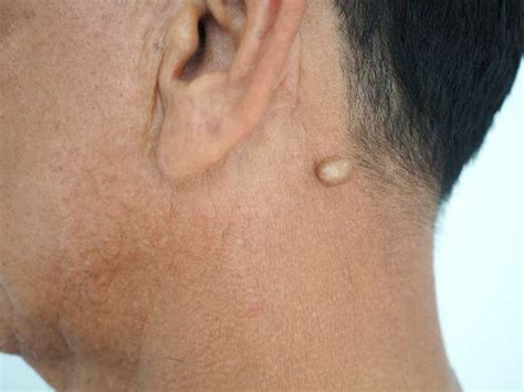 cancerous lumps  neck