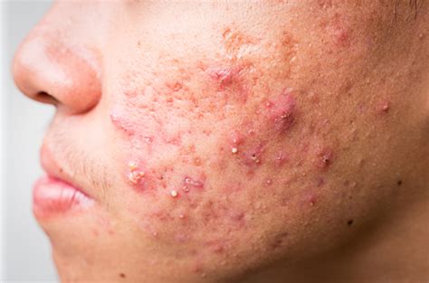 acne  types triggers  treatment options sg dermatologist