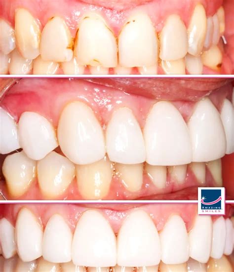 Choosing Between Composite Veneers Vs Porcelain Veneers