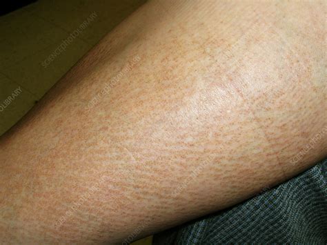 Amyloidosis - Stock Image - C056/5602 - Science Photo Library
