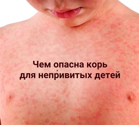 Корь — острое вирусное высококонтагиозное заболевание, передающееся ...