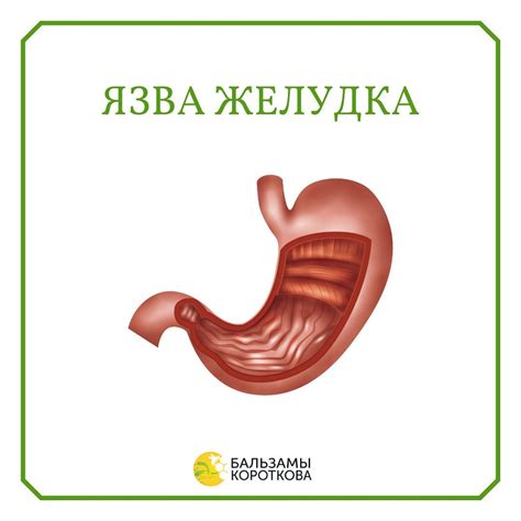 Язва желудка