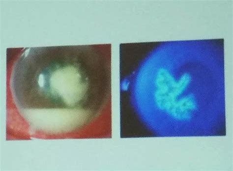 kesadaran  kebutaan kornea perlu ditingkatkan krjogja